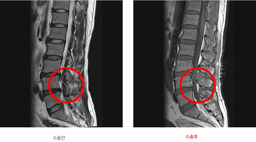 미세 현미경 디스크 제거술 진행 후 정상화된 신경을 나타낸 이미지