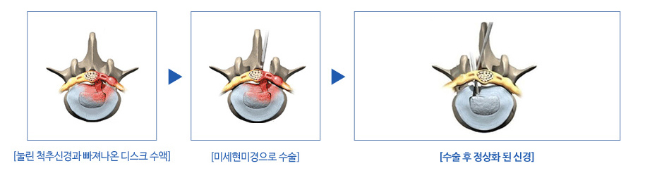 미세 현미경 디스크 제거술 진행 후 정상화된 신경을 나타낸 이미지