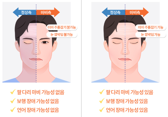안면신경마비, 갑자기 찾아온 얼굴마비! 원인, 증상